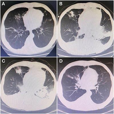 Case report: Nocardia farcinica pneumonia in early-stage post liver transplantation